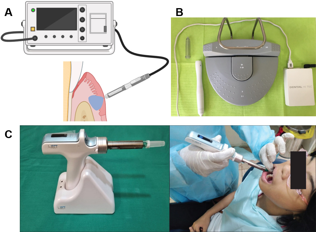 The demonstration of CCLAD and its application for local 
infiltration anesthesia for children. (A) The demonstration of CCLAD. (B) 
SleeperOne® device (From Vitale et al. [62], 2023, 
licensed under CC BY 4.0.). (C) Administering LA using I-JECT system (From Beegum 
et al. [63], 2024, licensed under CC BY 4.0.).