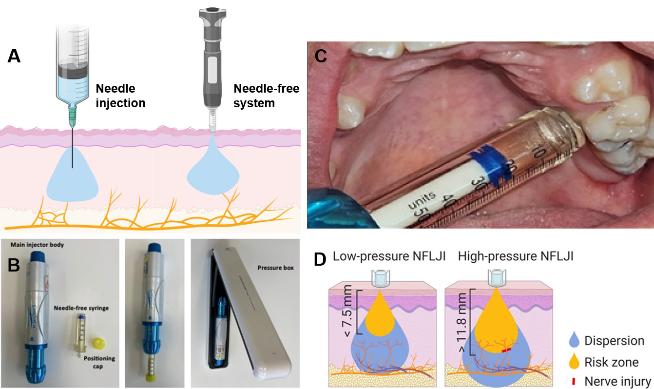Demonstration of needle-free system and its application for 
local infiltration anesthesia for children. (A) Demonstration of the needle-free 
system and needle injection. (B) Comfort-in™ injection system 
(Reproduced from Kaya et al. [67], 2023, with permission from the John 
Wiley &amp; Sons, Inc.). (C) Application of needle-free system for local anesthesia 
(From Altan et al. [69], 2025, licensed under CC BY 4.0.). (D) 
Penetration depth of anesthetic solution under different supply pressure (From 
Gao et al. [68], 2021, licensed under CC BY 4.0.). NFLJI: needle-free 
liquid jet injection.