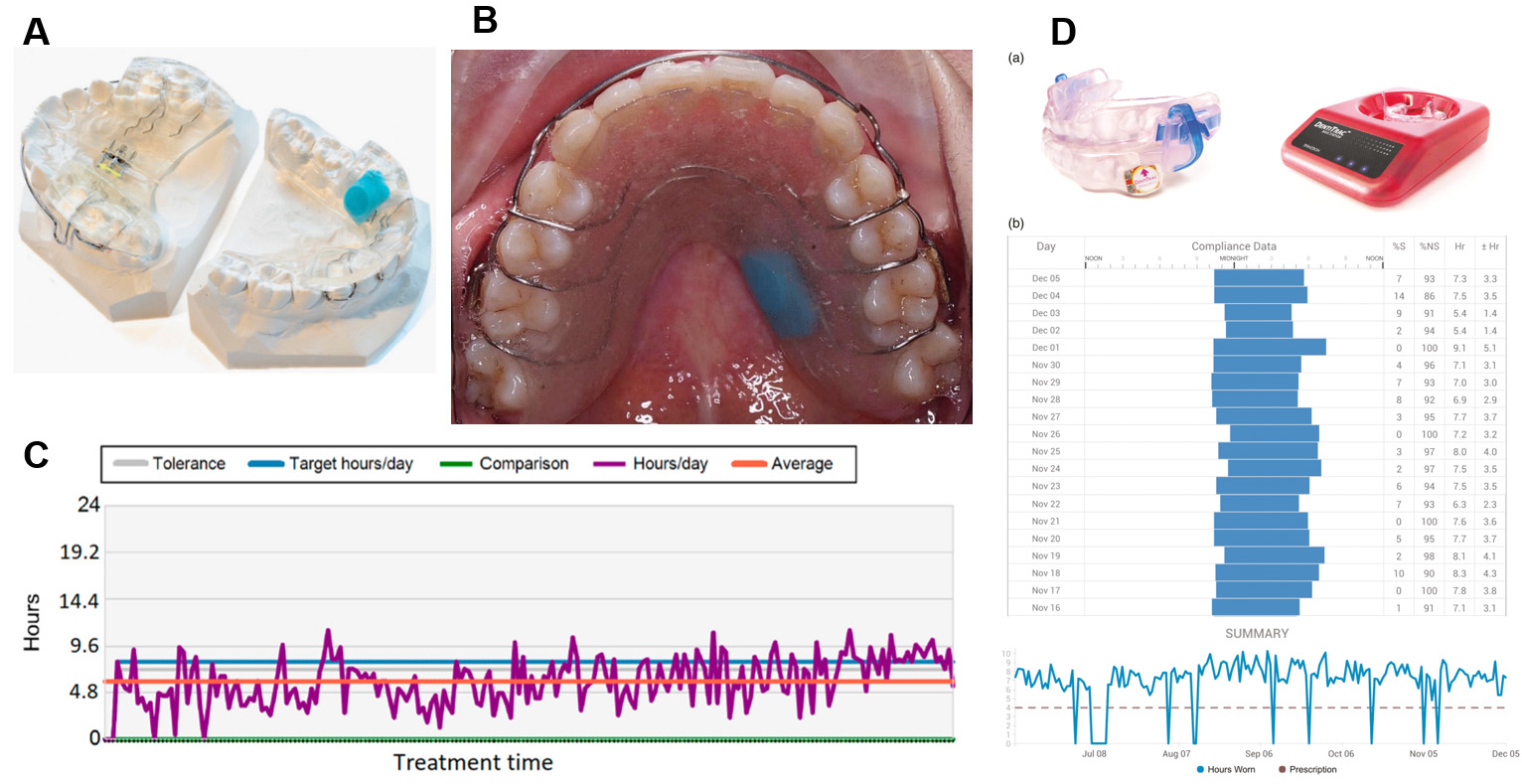Sensors are employed to remotely monitor the compliance for 
early orthodontic treatment. (A) Twin Block appliance with the 
TheraMon® microsensor in the mandibular lingual section (From 
Frilund et al. [108], 2023, licensed under CC BY 4.0.). (B) Microsensor 
embedded in upper removable Hawley retainer (From Khaled et al. [109], 
2023, licensed under CC BY 4.0.). (C) Demonstration of employing the software to 
convert sensor data into the wearing time of the appliance (From Nahajowski 
et al. [110], 2022, licensed under CC BY 4.0.). (D) (a) The 
DentiTrac® sensor embedded in the lower appliance (Left). The 
DentiTrac® base station (Right). (b) Example readout from the 
Braebon® Cloud Service, showing nightly wear duration over 200 
days (From Chen et al. [111], 2025, licensed under CC BY 4.0.).