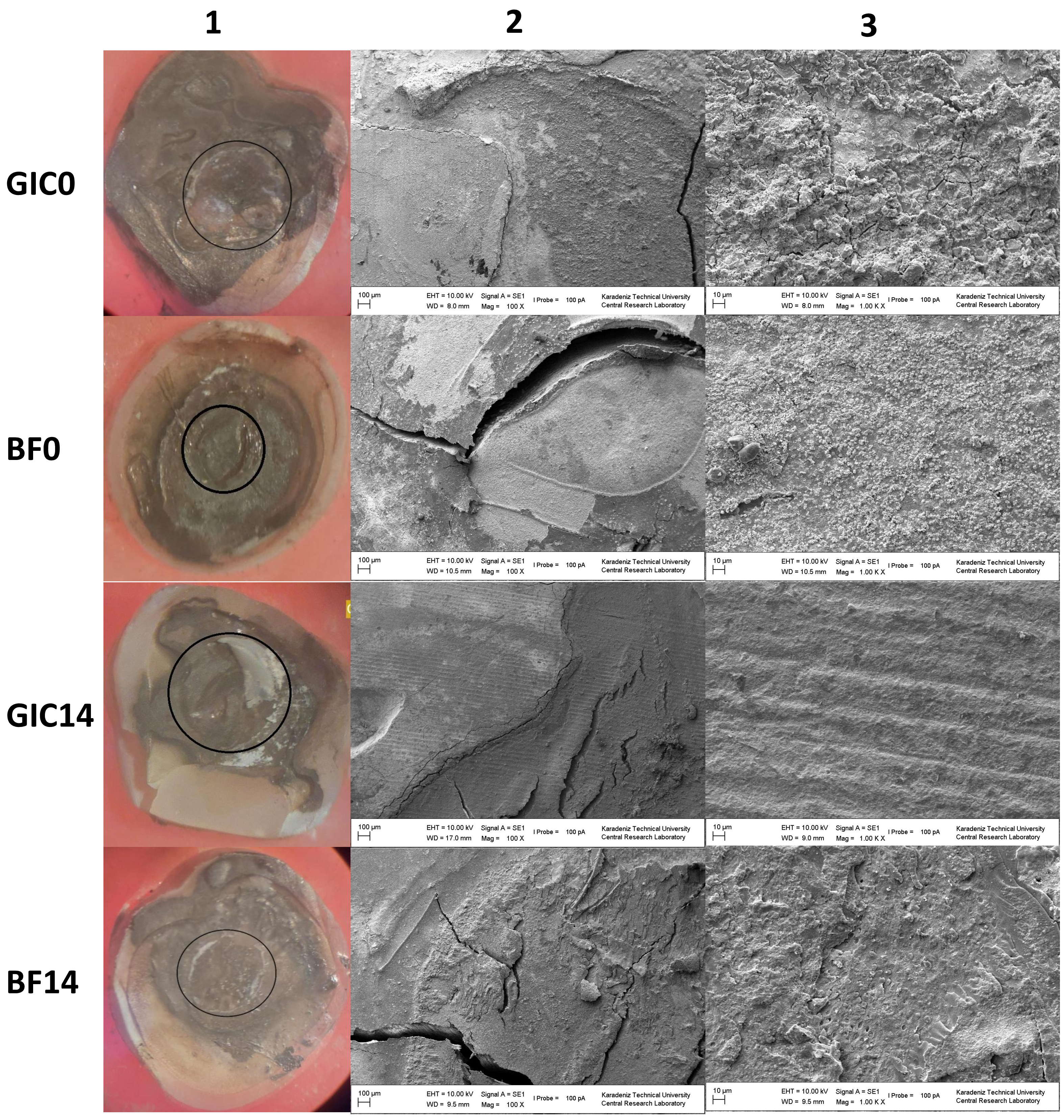 Micromorphological evaluation of restored
specimens. Representative stereomicroscopic
and SEM micrographs of the debonded surfaces obtained after the shear bond
strength test for each experimental group are shown. Images are presented at
three magnifications: (1) a 40× stereomicroscopic view showing the
standardized bonding area (circled), (2) an SEM image at 100×
magnification, and (3) an SEM image at 1000× magnification. The specimen
shown in BF0 illustrates an adhesive failure pattern, whereas the specimens shown
in the other groups illustrate mixed failure patterns. GIC0: resin-modified glass
ionomer cement—day 0; BF0: bulk-fill composite—day 0; GIC14: resin-modified
glass ionomer cement—day 14; BF14: bulk-fill composite—day 14; EHT: electron
high tension (accelerating voltage); WD: working distance; SE: secondary
electron; Mag: magnification.