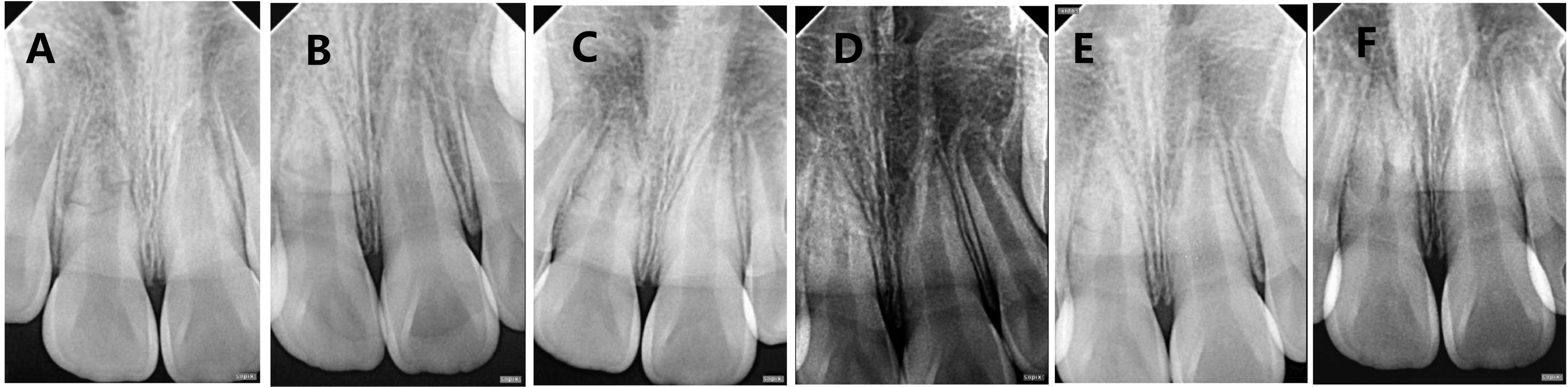 Calcified healing of horizontal root fracture in a young 
permanent tooth. (A) Initial X-ray. (B–F) correspond to 3 months, 6 months, 1 
year, 1.5 years, and 2 years after the trauma, respectively.