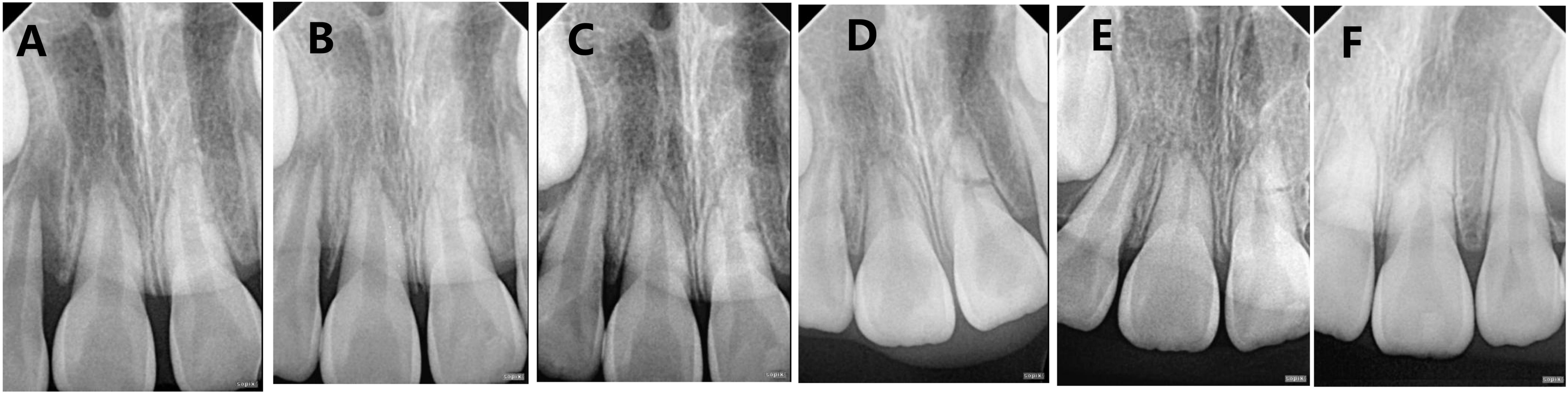 A case of connective tissue healing of horizontal root fracture 
in the middle part of a young permanent tooth. (A) Initial X-ray. (B–F) 
correspond to 3 months, 6 months, 1 year, 1.5 years, and 2 years after the 
trauma, respectively.