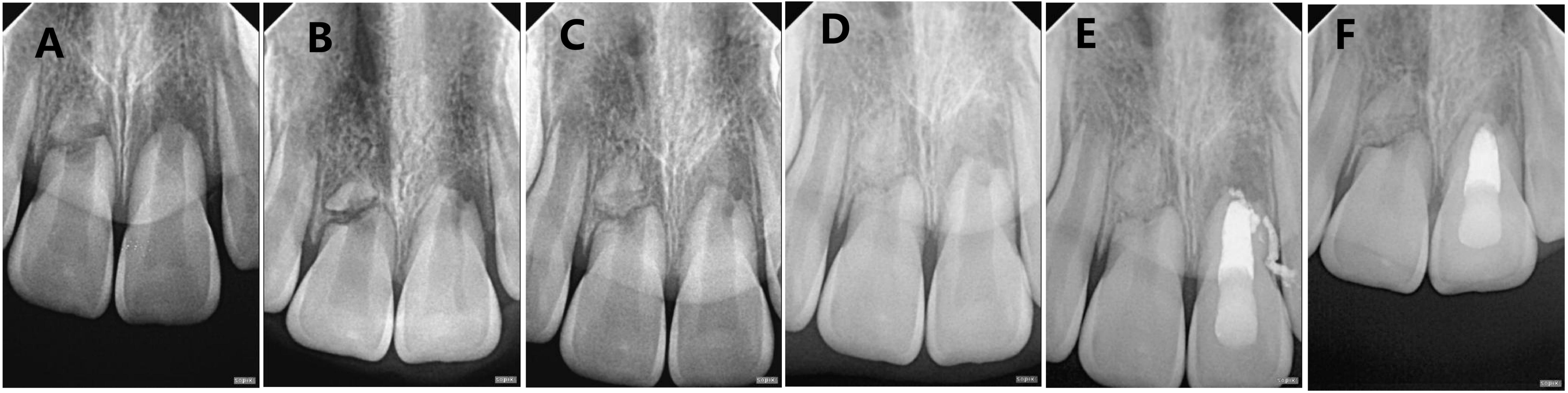 A case of bone and connective tissue healing of horizontal root 
fracture in a young permanent tooth. (A) Initial X-ray. (B–F) correspond to 3 
months, 6 months, 1 year, 1.5 years, and 2 years after the trauma, respectively.