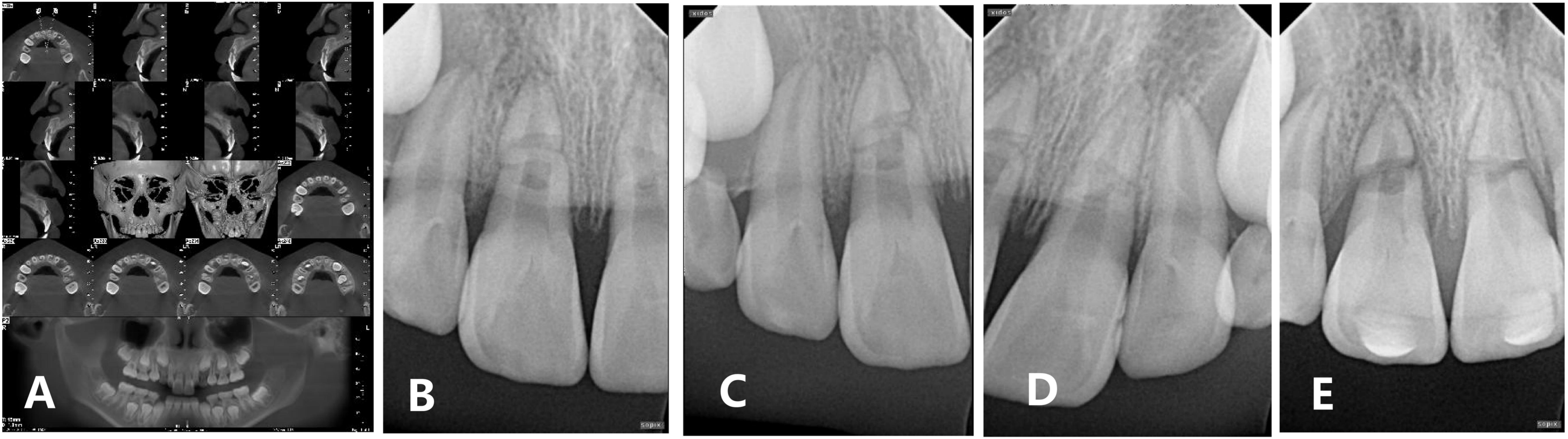 A case of inflammatory healing of horizontal root fracture in a 
young permanent tooth. (A) Initial CBCT examination. (B–E) correspond to 6 
months, 1 year, 1.5 years, and 2 years after the trauma, respectively.