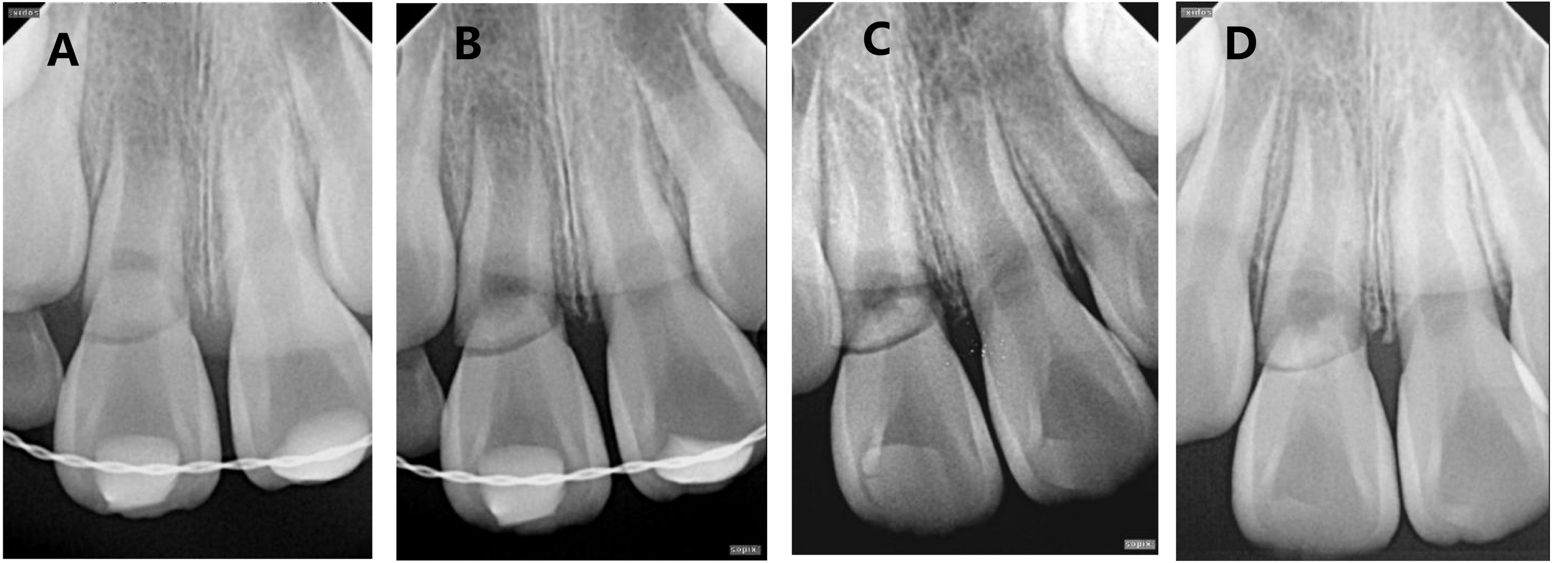 A case of connective tissue healing of horizontal root fracture 
at the cervical part with displacement in a young permanent tooth. (A) 
Post-repositioning and fixation X-ray. (B–D) correspond to 3 months, 1 year, 1.5 
years, respectively.