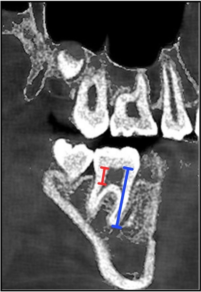 Sagittal CBCT section illustrating the 
morphometric measurement references on the mandibular right first molar (tooth 
46). T1, representing the pulp chamber height, was measured as the linear 
distance between the pulp chamber roof and the furcation area and is indicated by 
the red line. T2, representing the distance from the pulp chamber roof to 
the root apex, is indicated by the blue line. All measurements were performed 
along the long axis of the tooth, and the taurodontism index was calculated as 
T1/T2 × 100 according to the Shifman and Chanannel 
classification [3].
