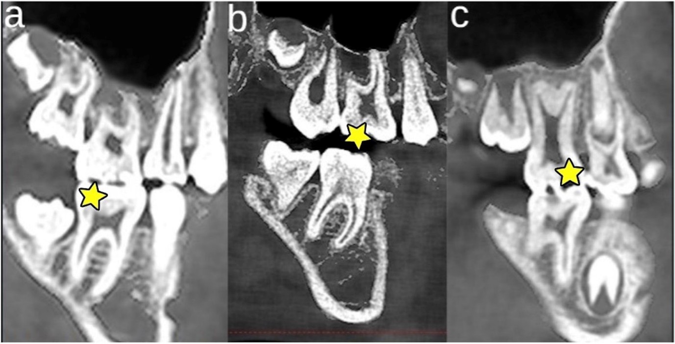 Representative sagittal CBCT sections illustrating different 
taurodontism morphologies in first permanent molars according to the Shifman and 
Chanannel classification [3]. (a) Hypotaurodont tooth showing mild apical 
displacement of the pulp chamber floor, (b) Mesotaurodont tooth showing moderate 
vertical enlargement of the pulp chamber, and (c) Hypertaurodont tooth 
characterized by marked apical elongation of the pulp chamber and shortened 
roots. The yellow star indicates the tooth evaluated for taurodontism 
classification in each image.