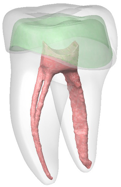 Solid model of the prepared tooth, pulp chamber, cement layer,
and prefabricated crown.