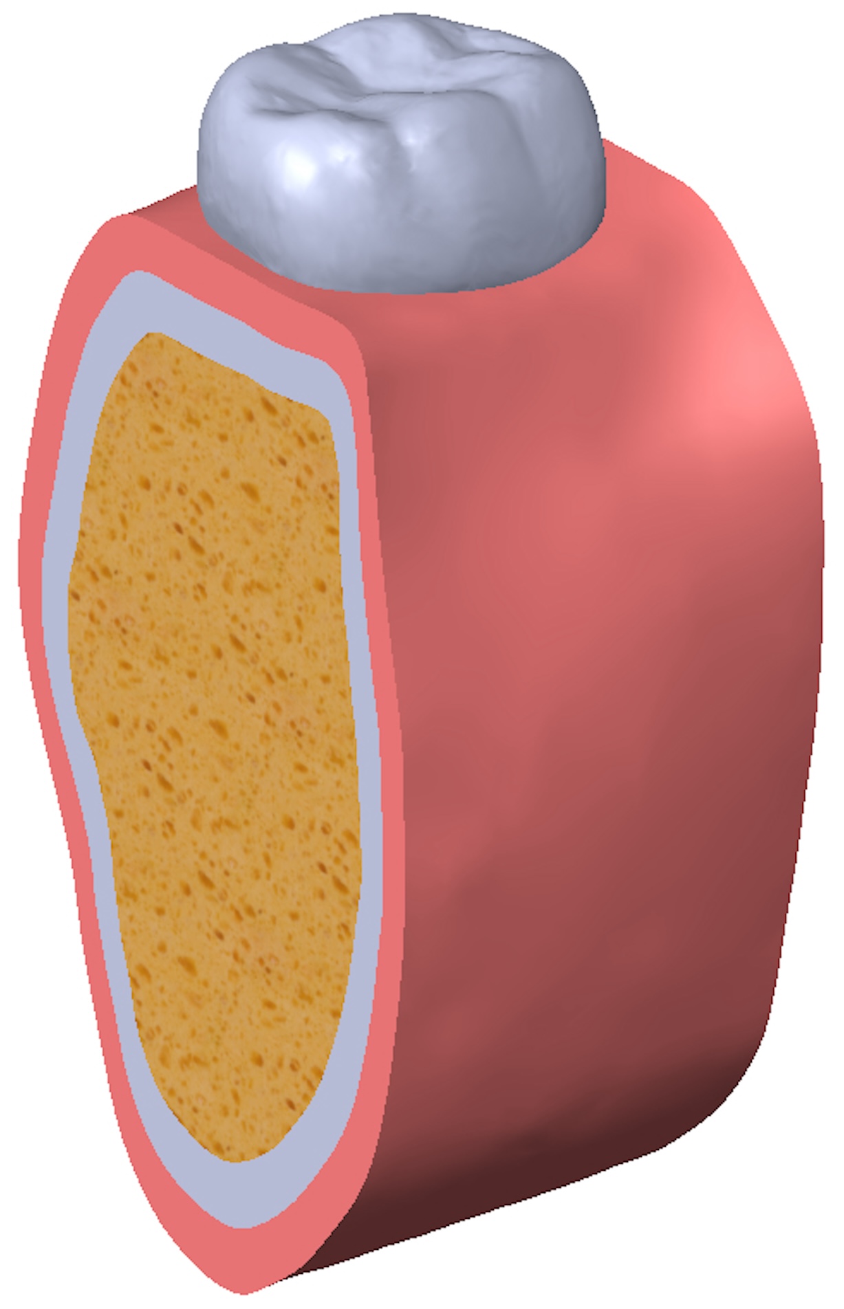 Solid model of cortical bone, trabecular bone, and gingival soft
tissue.