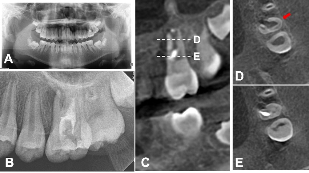 Preoperative Radiographs. (A) Panoramic radiograph and
periapical radiograph showing the previously initiated endodontic treatment on
tooth #26. (B) The palatal root has an immature, open apex. (C) Sagittal CBCT
view of the maxillary molar. Dashed lines D and E indicate the respective levels
of the apical and coronal axial image. (D) Axial CBCT image (apical area). The
red arrow points to the fused morphology of the mesiobuccal (MB), distobuccal
(DB), and palatal (P) root. (E) Axial CBCT image (coronal area).