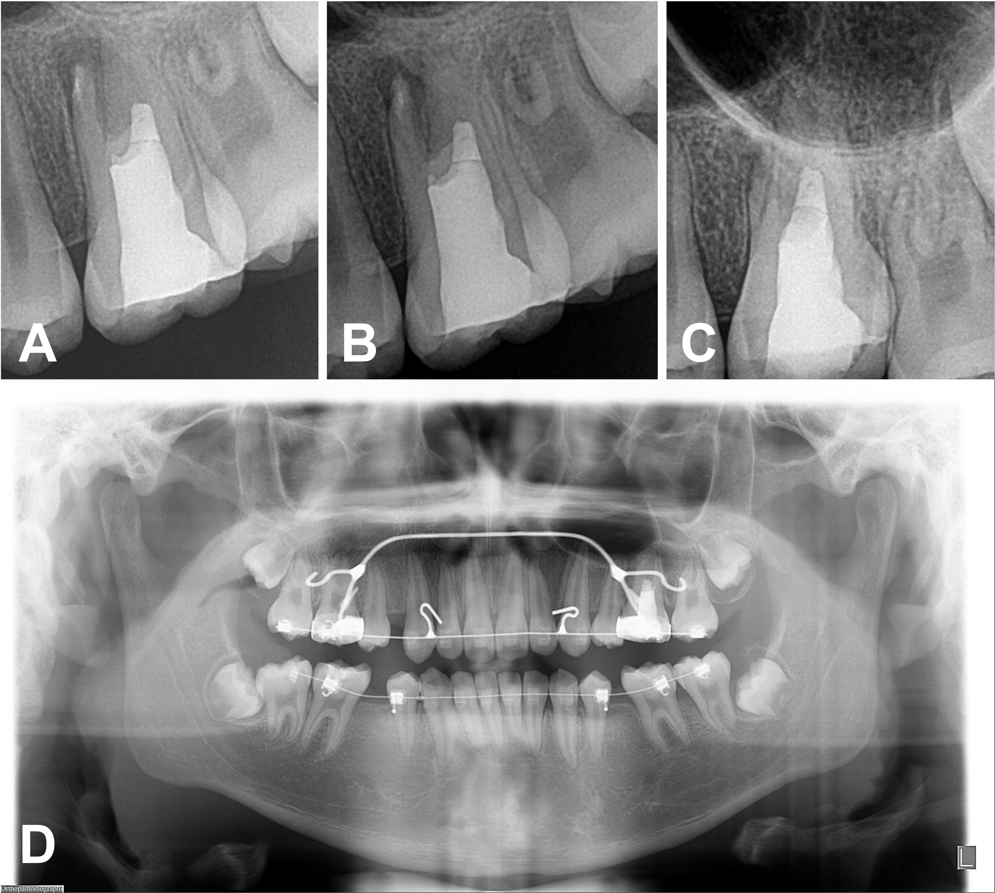 Serial postoperative radiographs. (A) Periapical radiograph
following root canal treatment. (B) Periapical radiograph at the 3-month recall.
(C) Periapical radiograph at the 1-year recall, showing a calcific barrier
directly beneath the mineral trioxide aggregate (MTA). (D) Panoramic radiograph
at 5-year and 6-month recall. The radiographs revealed no remarkable findings,
and the patient remained asymptomatic.