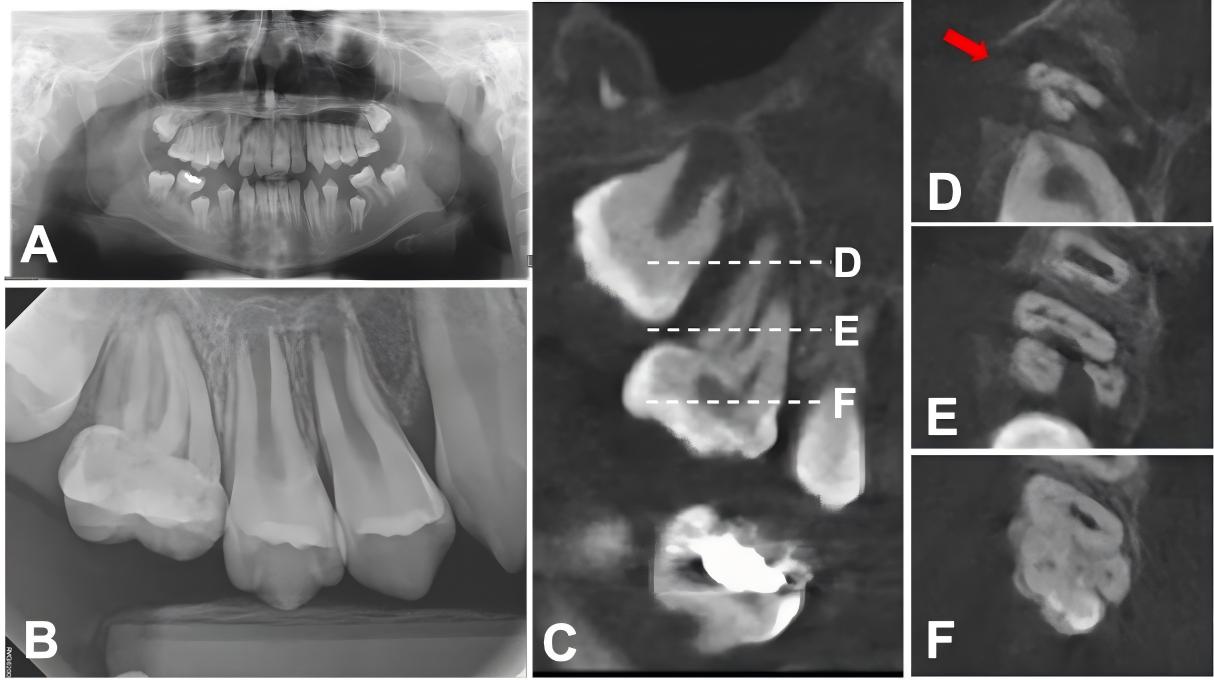Preoperative Radiographs. (A) Initial panoramic radiograph.
Molar-incisor malformation is evident in all maxillary and mandibular first
molars. (B) Periapical radiograph showing apical periodontitis at the right
maxillary first molar. (C) Sagittal CBCT view of the maxillary molar. Dashed
lines D, E, and F indicate the respective levels of the apical, middle, and
coronal axial image. (D) Axial CBCT image (apical area). The red arrow points to
a large periapical lesion. (E) Axial CBCT image (middle area). The CBCT image
reveals six canals: three mesiobuccal, two palatal, and one distobuccal. (F)
Axial CBCT image (coronal area), showing complex internal anatomy.