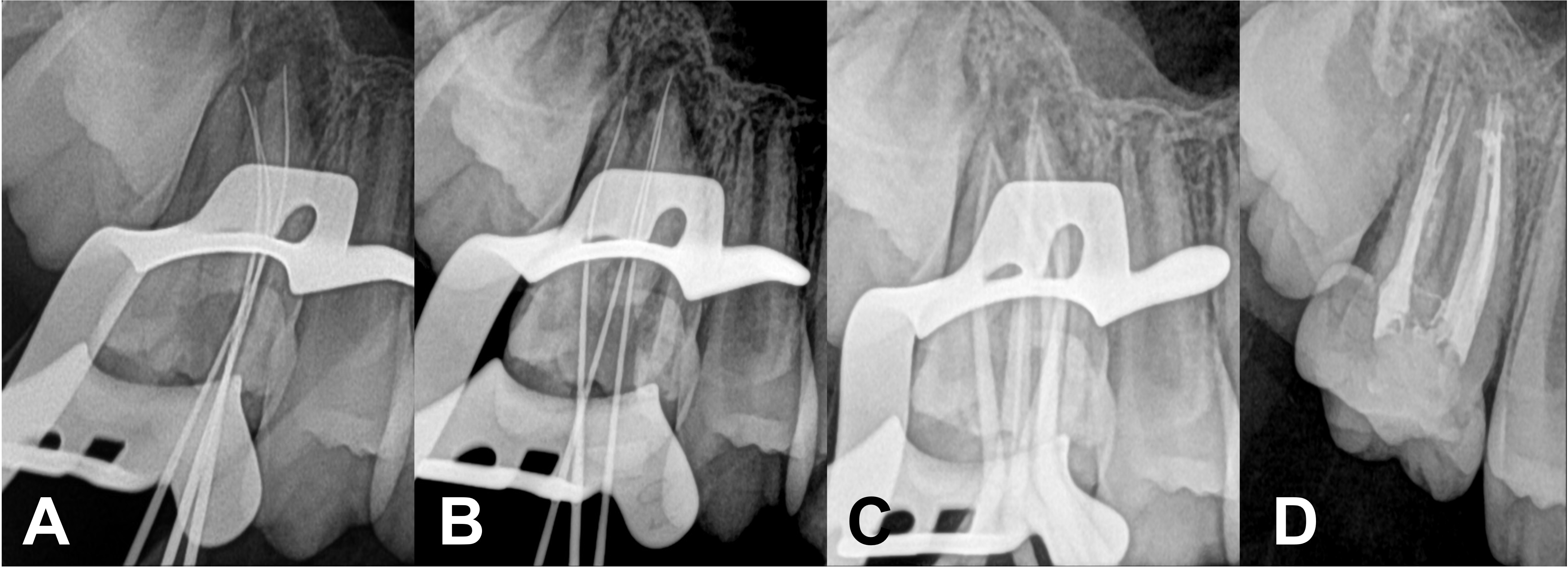 Serial periapical radiographs taken during root canal treatment.
(A) Working length determination radiograph using a #15 K-file. (B) Working
length determination radiograph using a #15 K-file. (C) Master cone filling
radiograph. (D) Post-obturation (canal filling and core restoration).