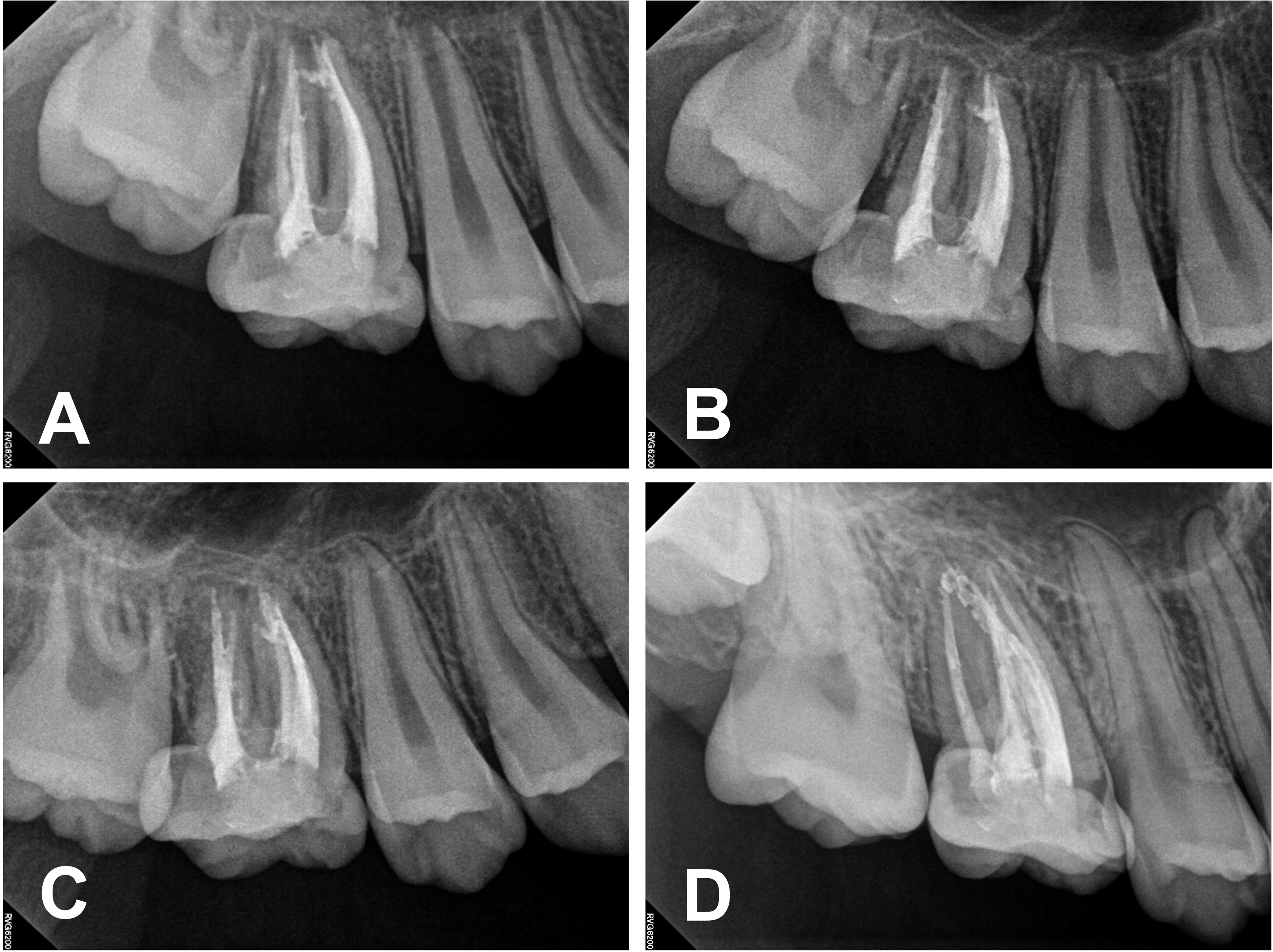Periapical radiographs at follow-up recalls: (A) 1 month, (B) 6
months, (C) 1 year, and (D) 6 years. All radiographs demonstrate normal, healed
periapical tissue.