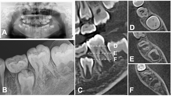 Preoperative Radiographs. (A) Initial panoramic radiograph. (B)
Periapical radiograph showing molar-incisor malformation in the left mandibular
first molar. (C) Sagittal CBCT view of the maxillary molar. Dashed lines D, E,
and F indicate the respective levels of the apical, middle, and coronal axial
image. (D) Axial CBCT image (coronal area), showing complex internal anatomy. (E)
Axial CBCT image (middle area), revealing five canals in the left mandibular
first molar: three mesiobuccal, two distal. (F) Axial CBCT image (apical area).
Widening of the periodontal ligament (PDL) space is observed at the distal root
apex.