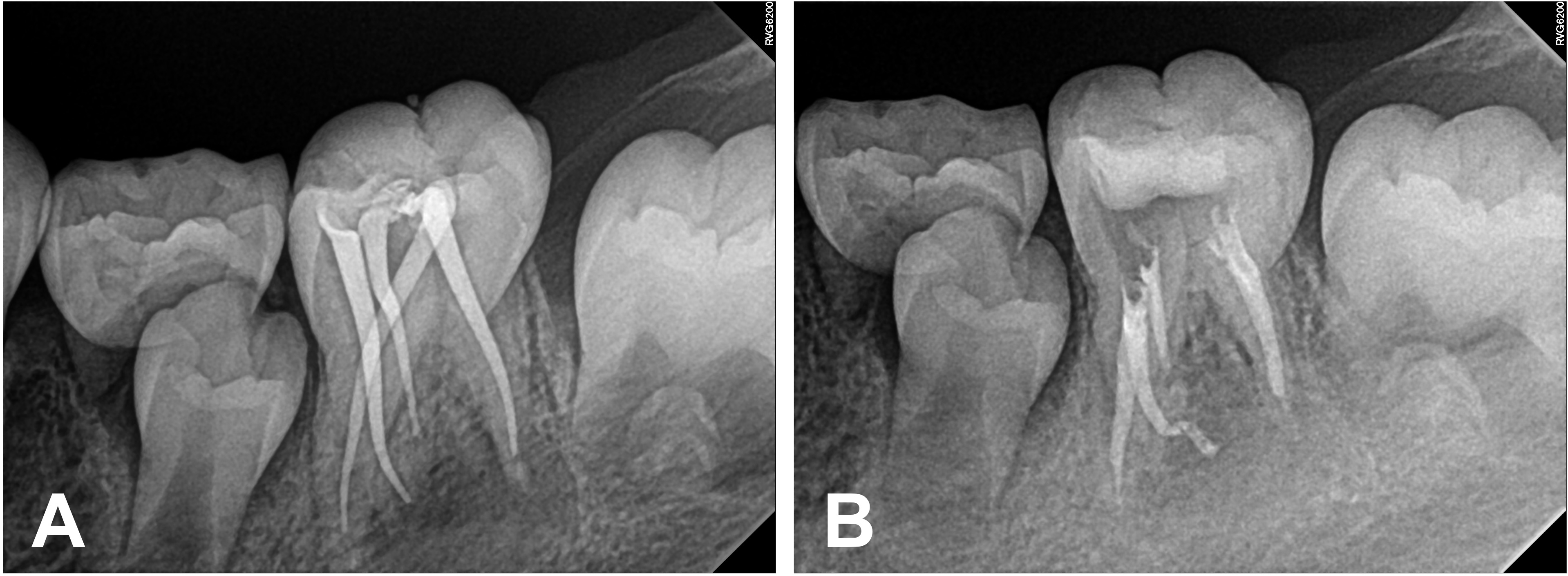 Serial periapical radiographs taken during root canal treatment.
(A) Working length determination radiograph using a gutta-percha cone. (B)
Post-obturation radiograph showing canal filling.