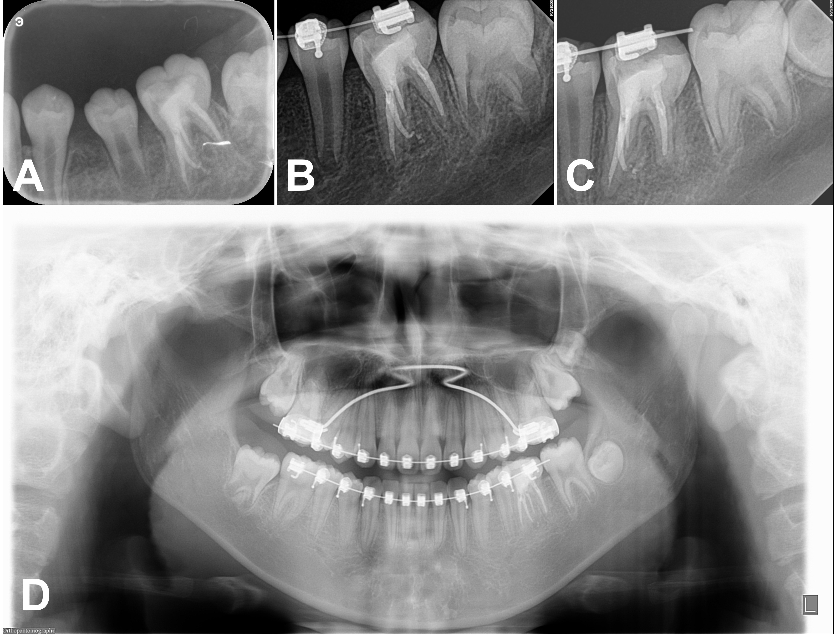 Serial postoperative radiographs. Follow-up radiographs: (A)
Periapical, 4-month recall. (B) Periapical, 1-year, 2-month recall. (C)
Periapical, 3-year recall. (D) Panoramic, 4-year recall. All images demonstrate
normal, healed periapical tissue.