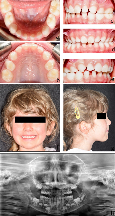 Clinical records of Case 1. A 5-year-old patient presenting
with a right unilateral posterior crossbite and Class II malocclusion with
increased overjet, before treatment. (a–e) intraoral photographs;
(f,g) extraoral photographs; (h) orthopantomogram.