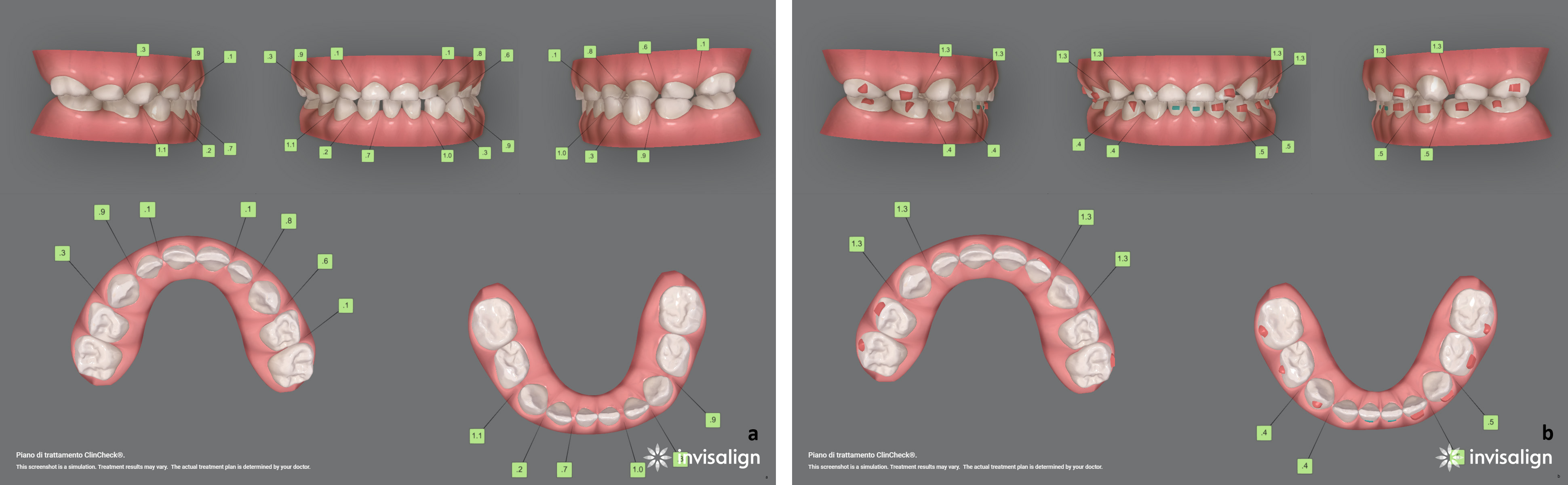 ClinCheck® of Case 3. Initial (a) and final
(b) ClinCheck® after application of the Baby First Expansion
Protocol; numbers in green boxes indicate interproximal spaces planned to
accommodate wider permanent teeth.