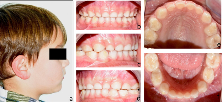 Case 3 at the end of treatment. (a) extraoral photograph after
treatment; (b–f) intraoral records after application of the Baby First Expansion
Protocol.