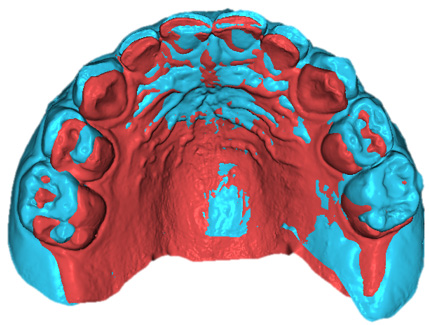 Case 3 superimposition. Superimposition of the upper arch
T1–T0.