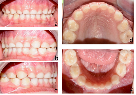 Case 3 follow-up. Patient 8 months after completion of
treatment, without retention. (a–e) intraoral photographs.