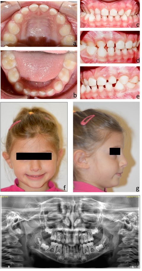 Clinical records of Case 2. A 5-year-old patient presenting
with Class I malocclusion and right unilateral posterior crossbite, before
treatment. (a–e) intraoral photographs; (f,g) extraoral photographs; (h)
orthopantomogram.