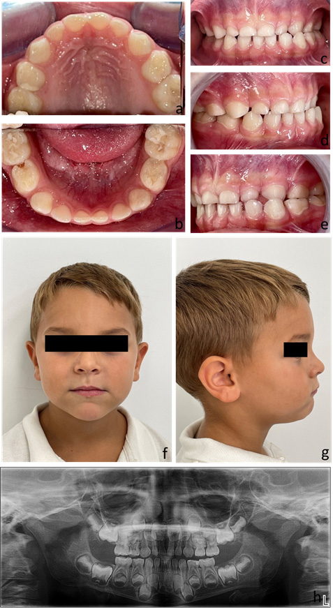 Clinical records of Case 3. A 5.2-year-old patient presenting
with Class III malocclusion and left unilateral posterior crossbite, before
treatment. (a–e) intraoral photographs; (f,g) extraoral photographs; (h)
orthopantomogram.