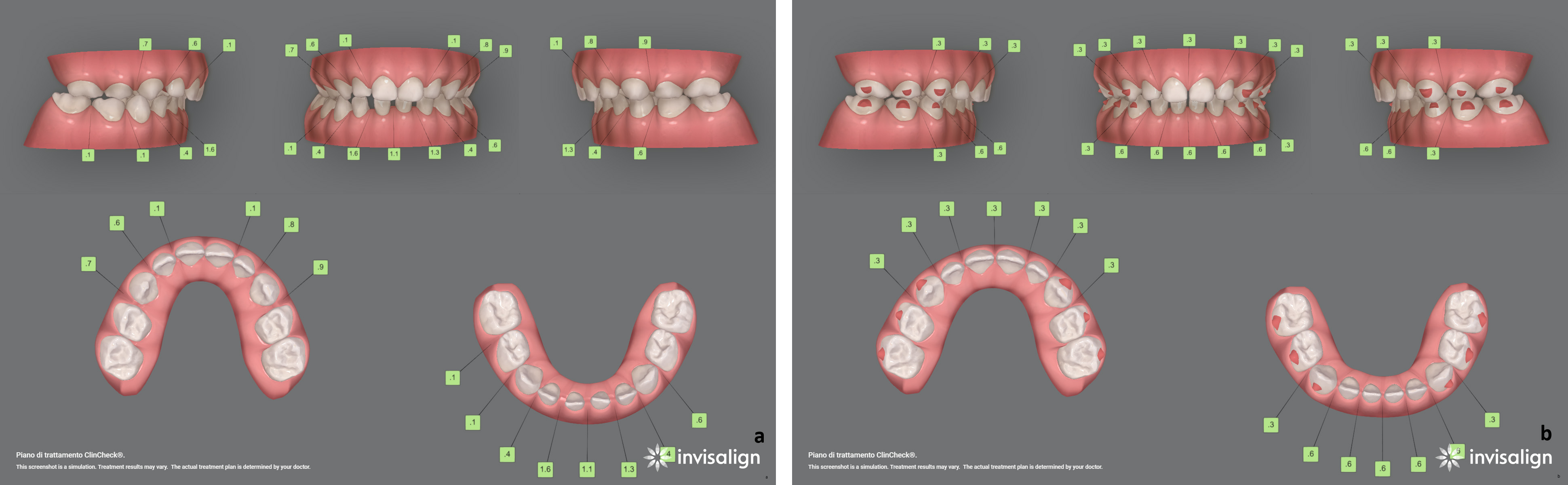 ClinCheck® of Case 1. Initial (a) and final (b)
ClinCheck® showing the application of the Baby First Expansion
Protocol; numbers in green boxes indicate interproximal spaces planned to
accommodate wider permanent teeth.