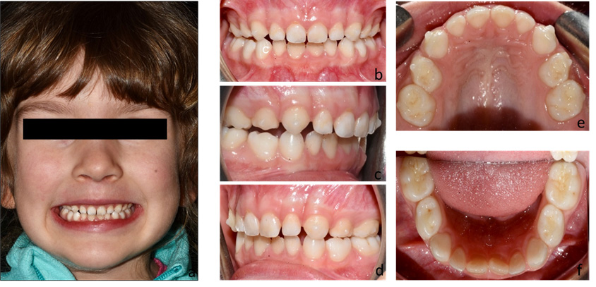Case 1 at the end of treatment. (a) Patient’s smile after
treatment; (b–f) intraoral records after application of the Baby First Expansion
Protocol.