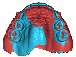 Case 1 superimposition. Superimposition of the upper arch
T1–T0.