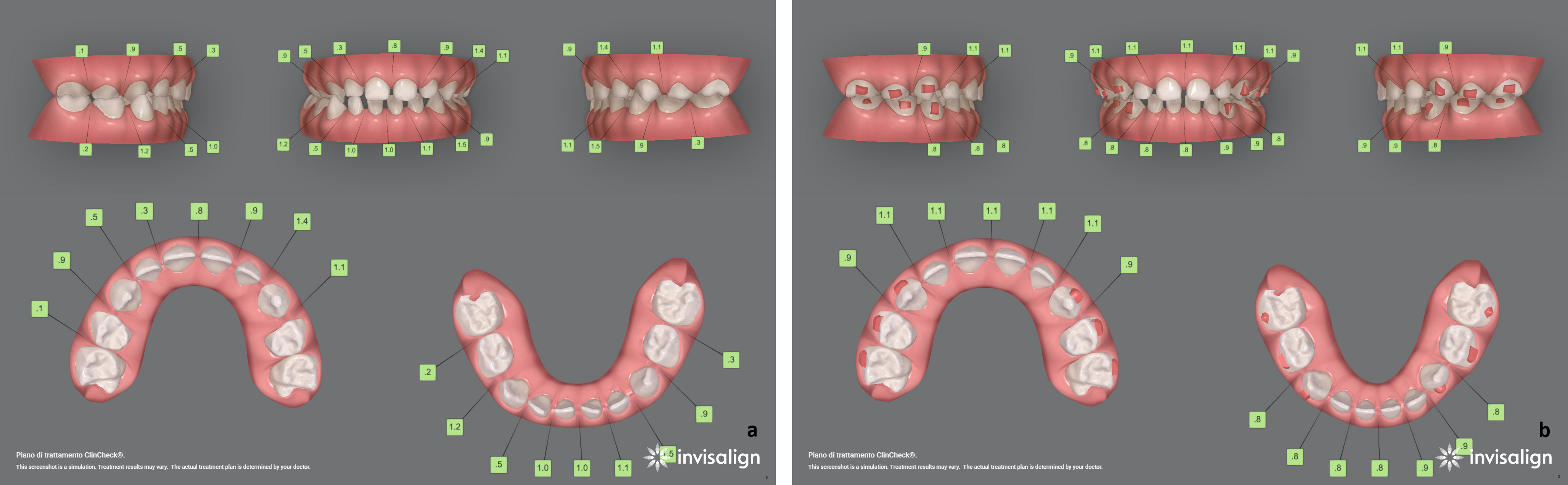 ClinCheck® of Case 2. Initial (a) and final (b)
ClinCheck® after application of the Baby First Expansion
Protocol; numbers in green boxes indicate interproximal spaces planned to
accommodate wider permanent teeth.