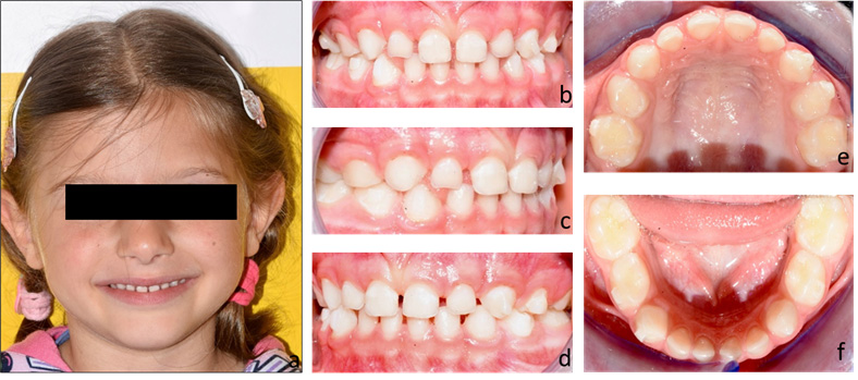 Case 2 at the end of treatment. (a) Patient’s smile after
treatment; (b–f) intraoral records after application of the Baby First Expansion
Protocol.