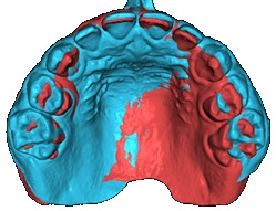 Case 2 superimposition. Superimposition of the upper arch
T1–T0.