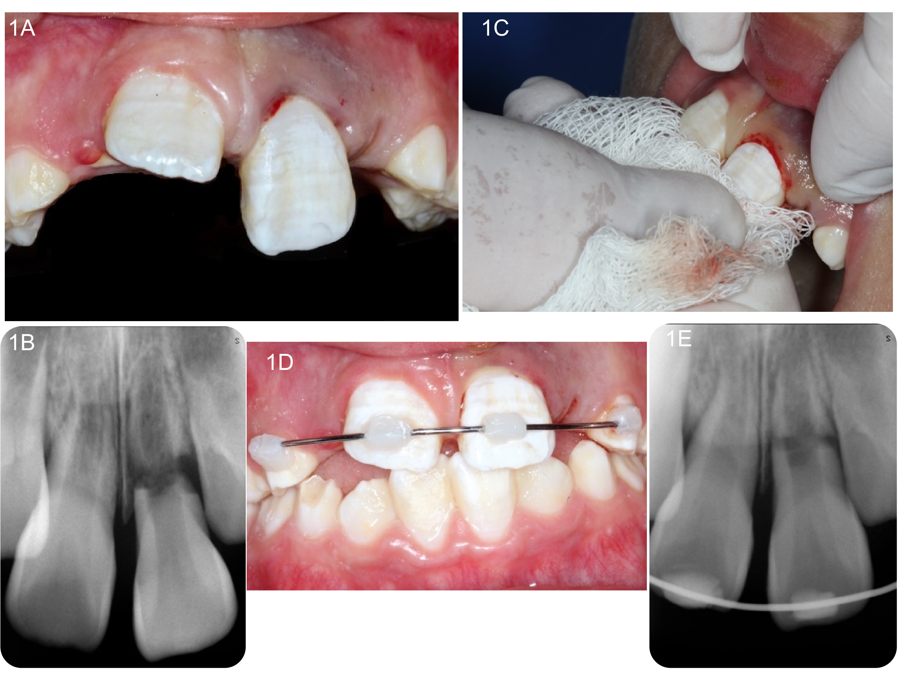 Preoperative clinical status and initial management. (A)
Clinical presentation of tooth #9; (B) Preoperative periapical radiograph
displaying an oblique root fracture between the middle and cervical thirds, with
a palatally displaced coronal fragment and incomplete root development; (C)
Reduction of the coronal fragment achieved using sterile gauze and digital
pressure; (D) Splint placement, including both central incisors and primary
canines; (E) Immediate postoperative radiograph demonstrating successful
reduction of the fracture.