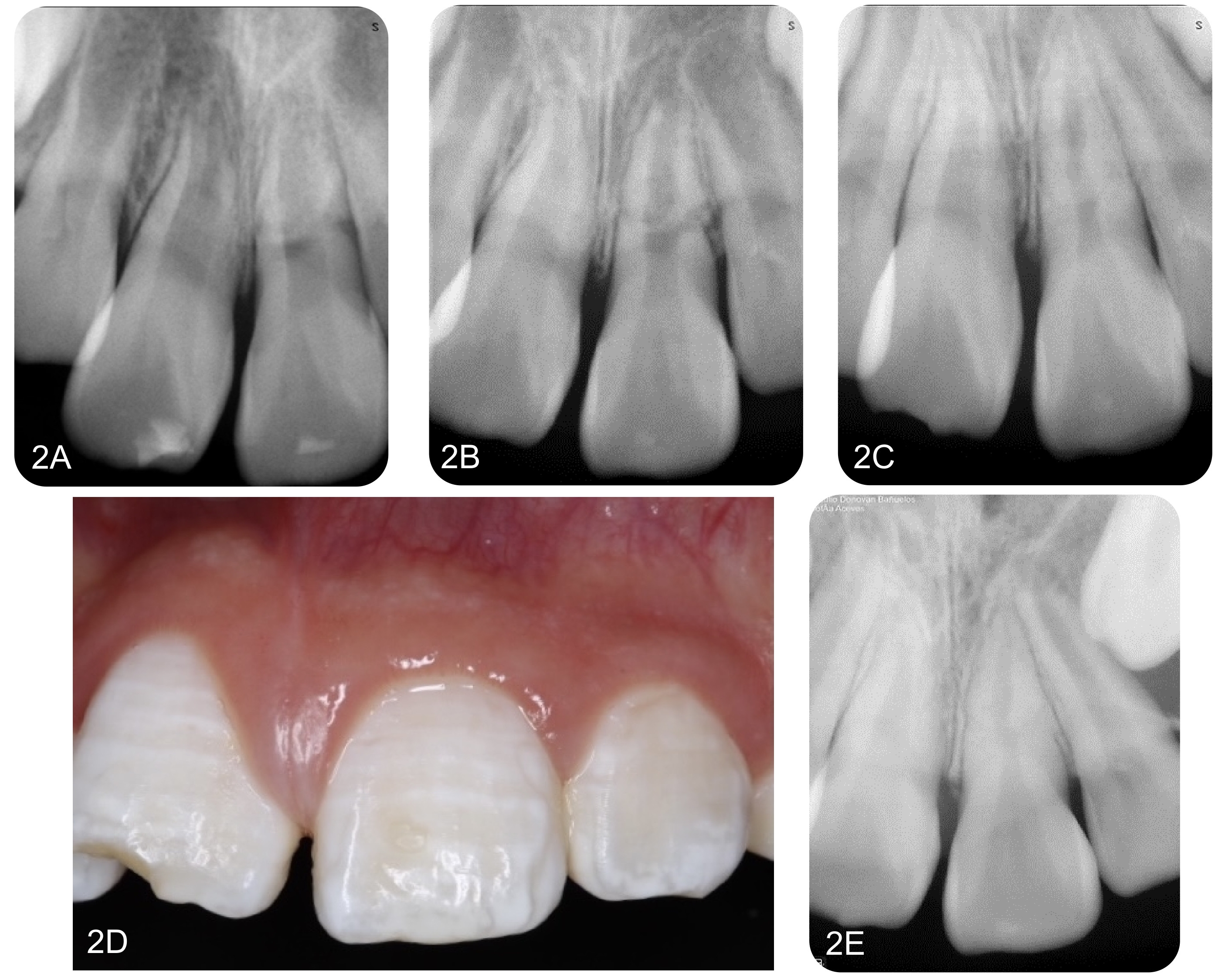 Follow-up evaluation from 2 to 24 months. (A) Follow-up at 2
months. The patient lost the splint two weeks prior due to a subsequent fall; (B)
Follow-up at 6 months; (C) Follow-up at 14 months; (D,E) Clinical and
radiographic follow-up 24 months post-trauma. The clinical crown exhibits a color
and tone similar to its counterpart.