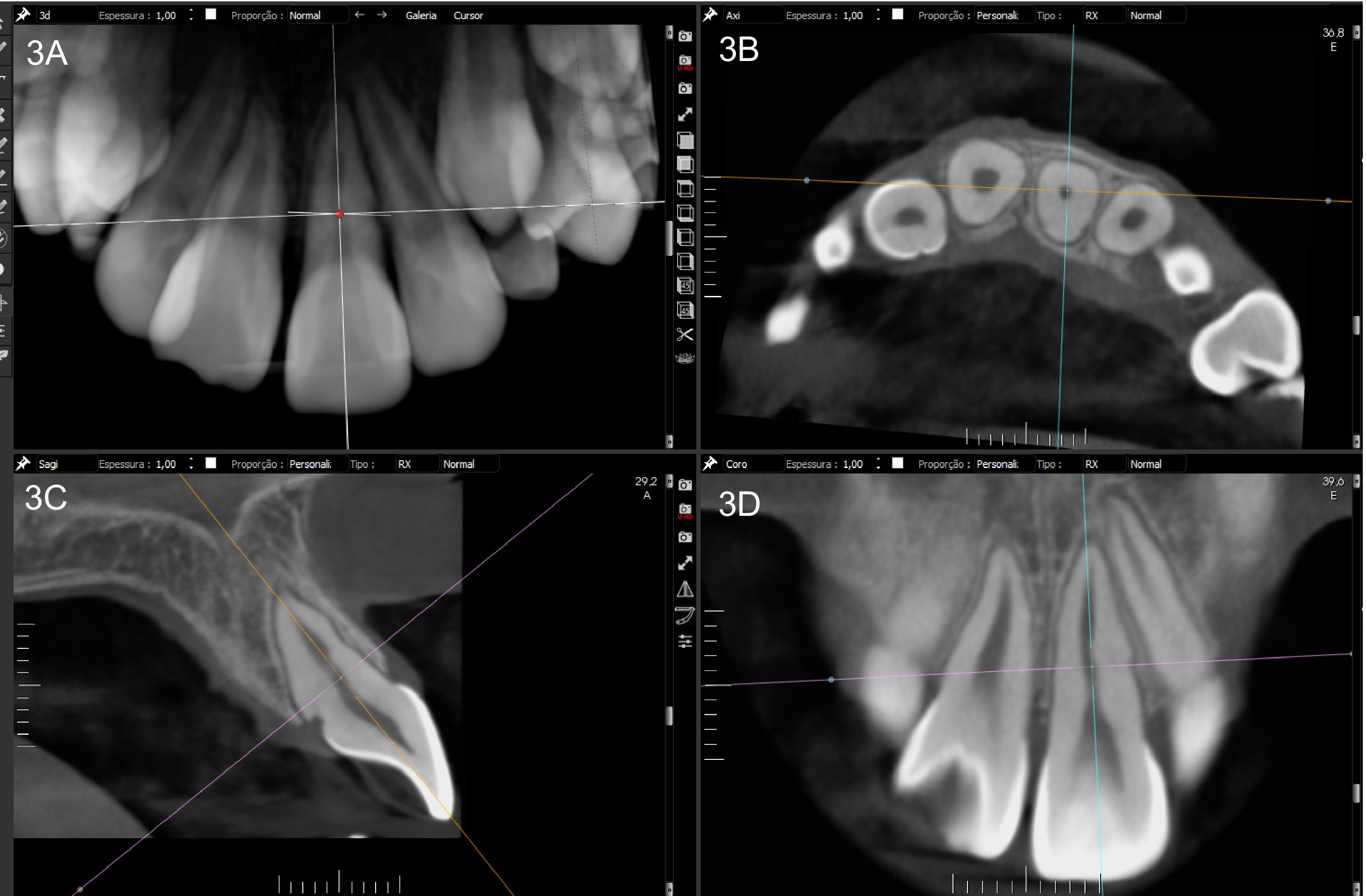 CBCT image obtained after 37 months of follow-up. CBCT images
in various planes illustrate the healing of the fracture line, albeit with a
slight fracture line and normal tissue. Root development is now complete.
Multiplanar reconstruction (MPR) lines delineate the fracture region in the (A,D)
coronal, (B) axial and (C) sagittal planes, illustrating the healing progression
of the oblique root fracture.