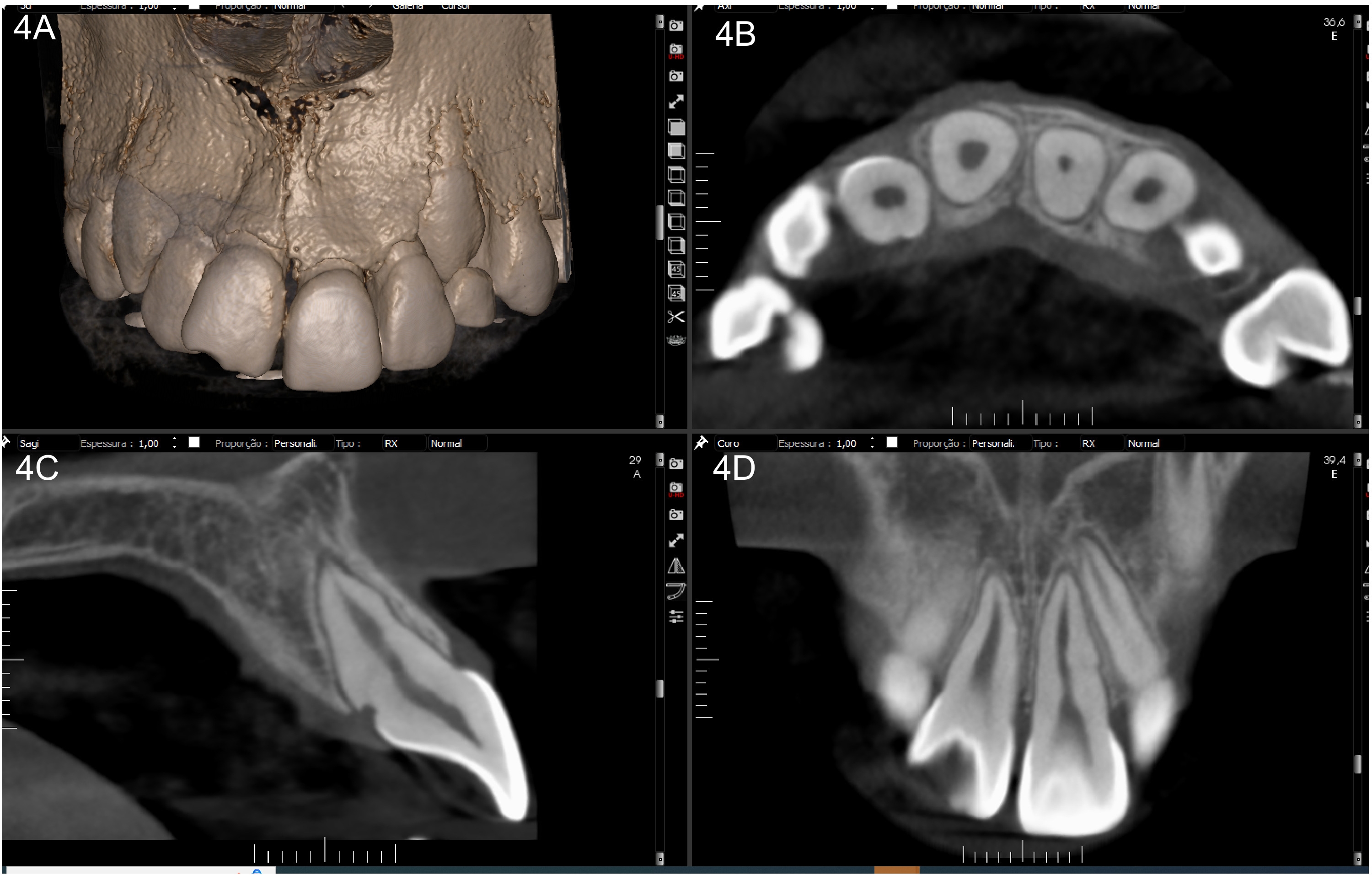 CBCT images without delineated lines after 37 months of
follow-up. (A) High-resolution MPR showing normal vestibular bone tissue. (B)
Axial section showing dentin formation at the fracture site, as well as a
reduction in root canal diameter. (C) In the cervical third of the palatal root,
there is a slight loss of root surface attributed to trauma. The integrity of
both cortical bones is evident. (D) The periapical tissues appear normal.