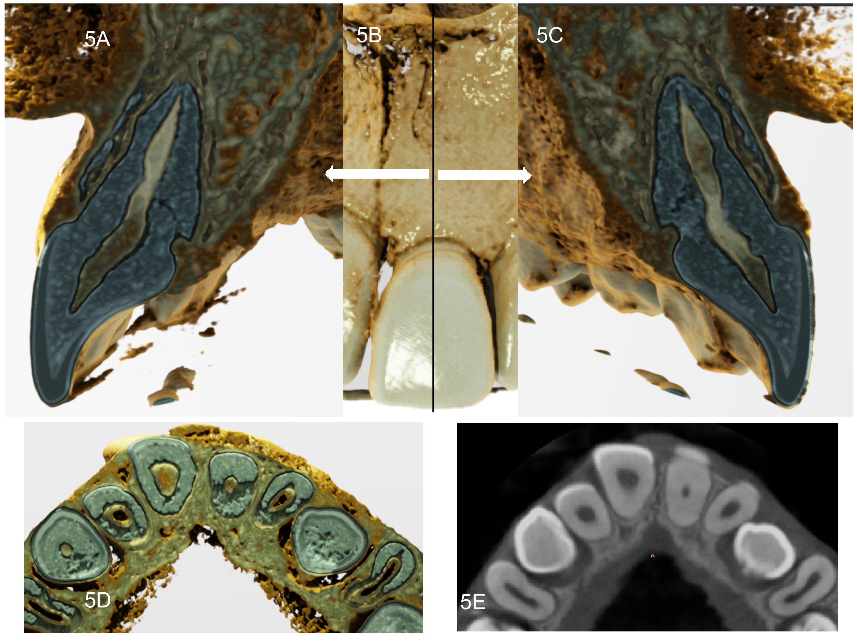 Cinematic representation of CBCT with 3D volumetric details.
Fig. 5B shows the view from the left (A) or right (C) side of the central
incisor in a digital sagittal section, as well as an axial view (D). The root’s
integrity and normality are evident, including the healing of the root fracture
line and the presence of normal periodontal structures. (E) CBCT axial section
showing the difference in dentin wall thickness between the two central incisors,
with the fractured tooth having thicker walls.