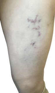 Hemangioma of the left lower limb.
