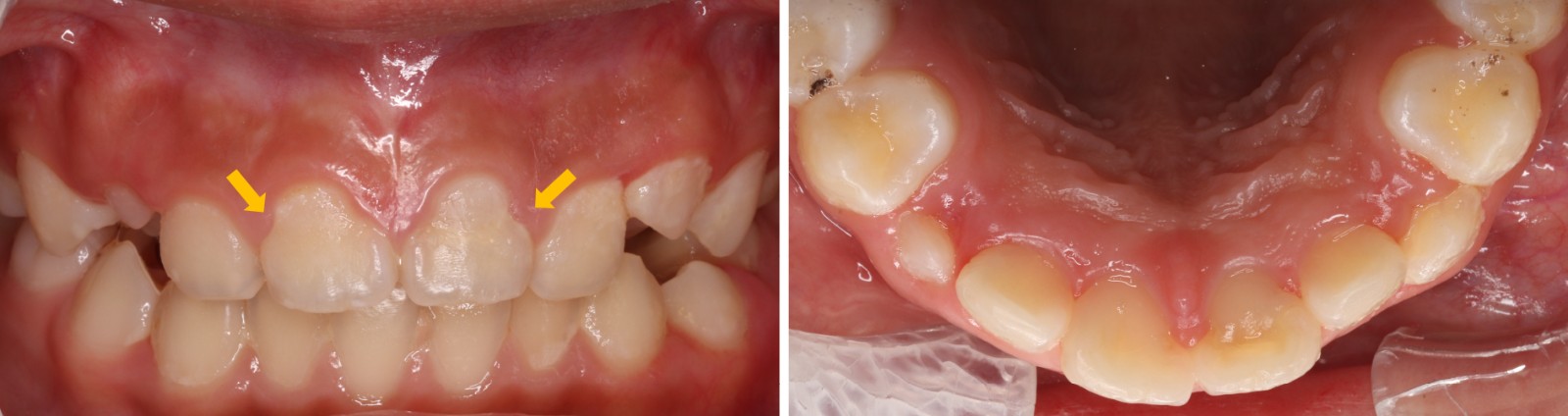 Intraoral photographs at first visit. The yellow arrows showing the cervical constriction of teeth 11 and 21.