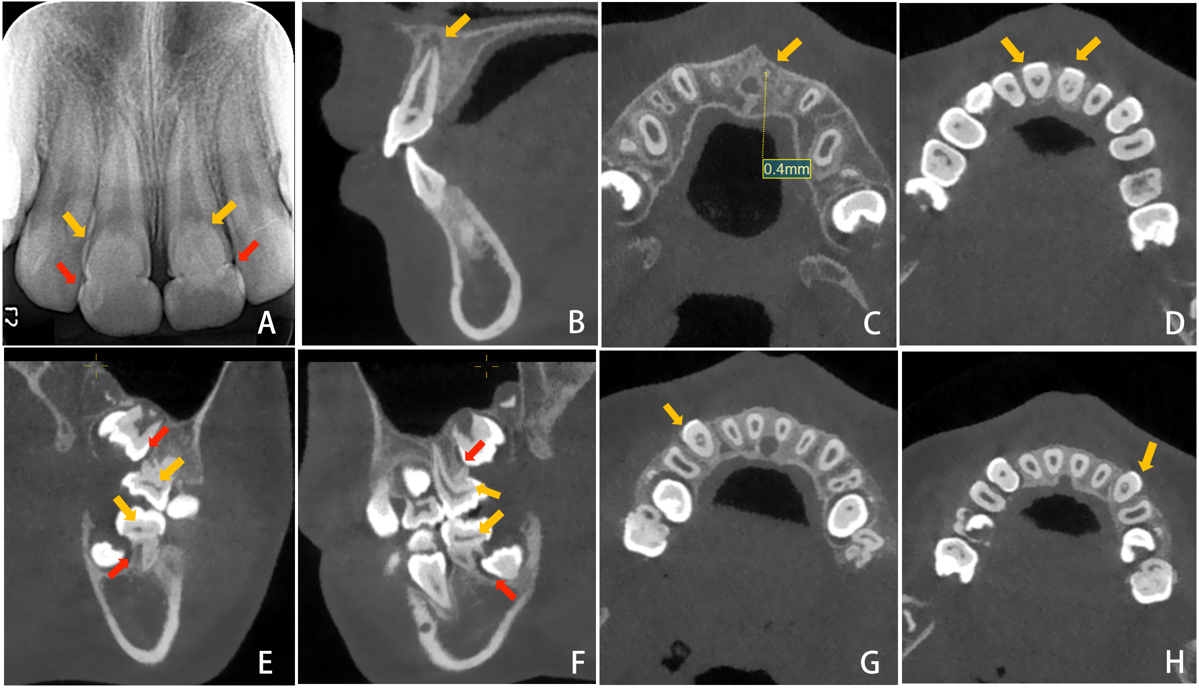 Initial radiographs. (A) Periapical radiograph. The yellow arrows showing the pulpal calcifications, and the red arrows showing the wedge-shaped radiolucent defects at the cervical areas of teeth 11 and 21. (B) Periapical radiolucency (the yellow arrow) associated with tooth 21. (C) The apical foramen of tooth 21 showing an estimated opening diameter of approximately 0.4 mm (the yellow arrow). (D) Calcified masses (the yellow arrows) in the pulp chambers of teeth 11, 21. (E,F) Narrow and linear pulp chambers (the yellow arrows) in teeth 16, 26, 36, and 46; incomplete development of the distal roots (the red arrows) of the first permanent molars; teeth 17, 27, 37, and 47 impacted at the distal cervical root area of the first molars. (G,H) Calcified masses (the yellow arrows) in the pulp chambers of teeth 13, 23.