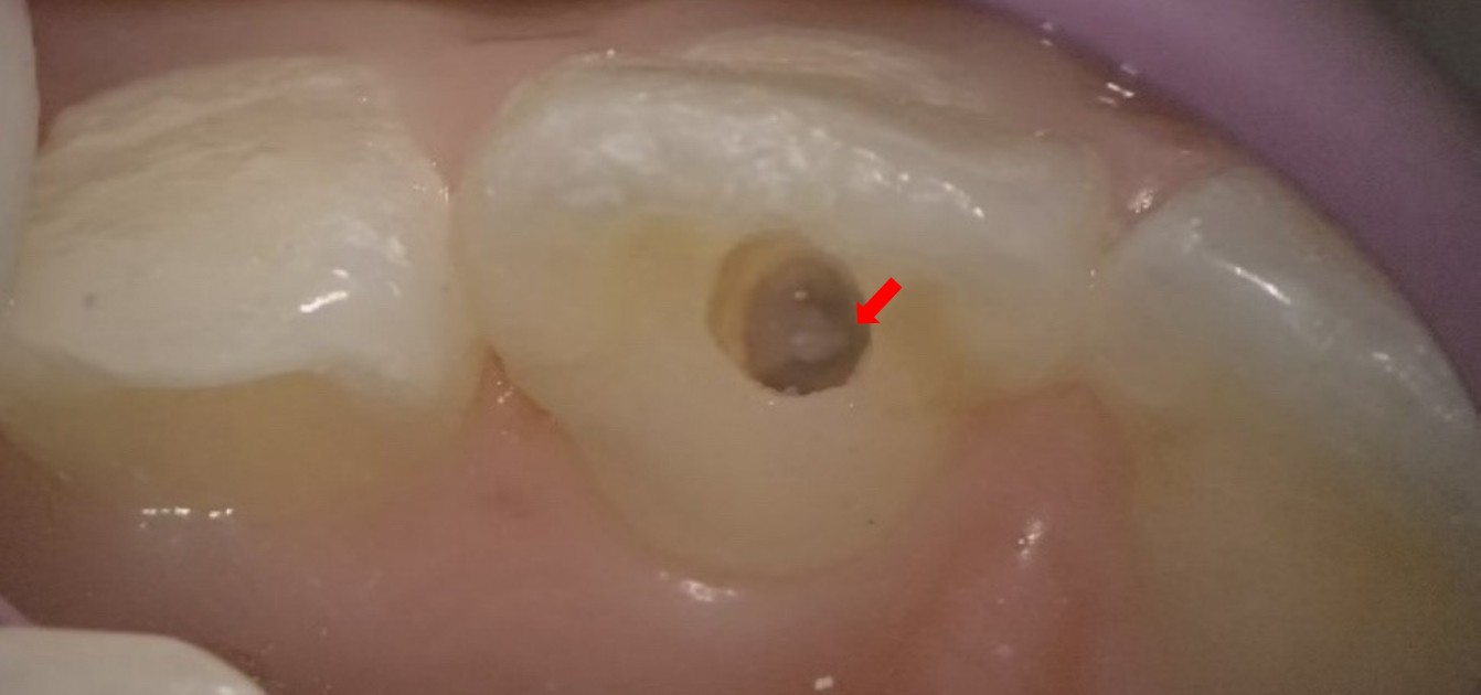 Calcified mass (the red arrow) in the pulp chamber of tooth 21 under the microscope.