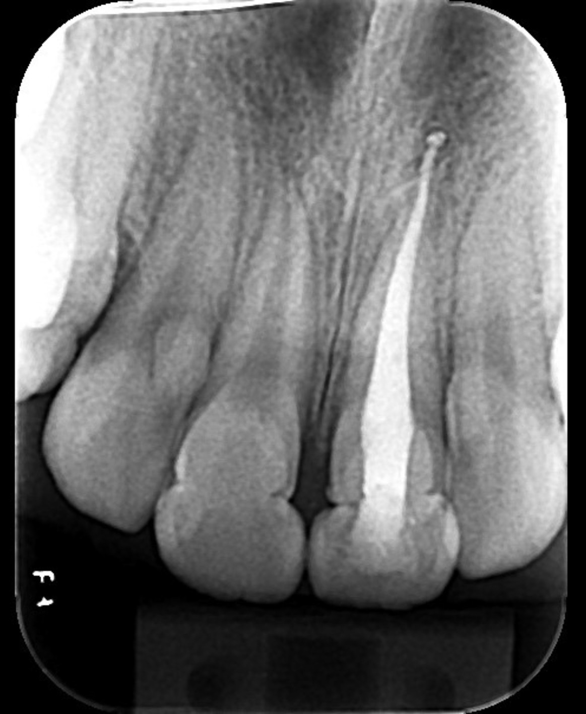 Immediate postoperative periapical radiograph after root canal
treatment.