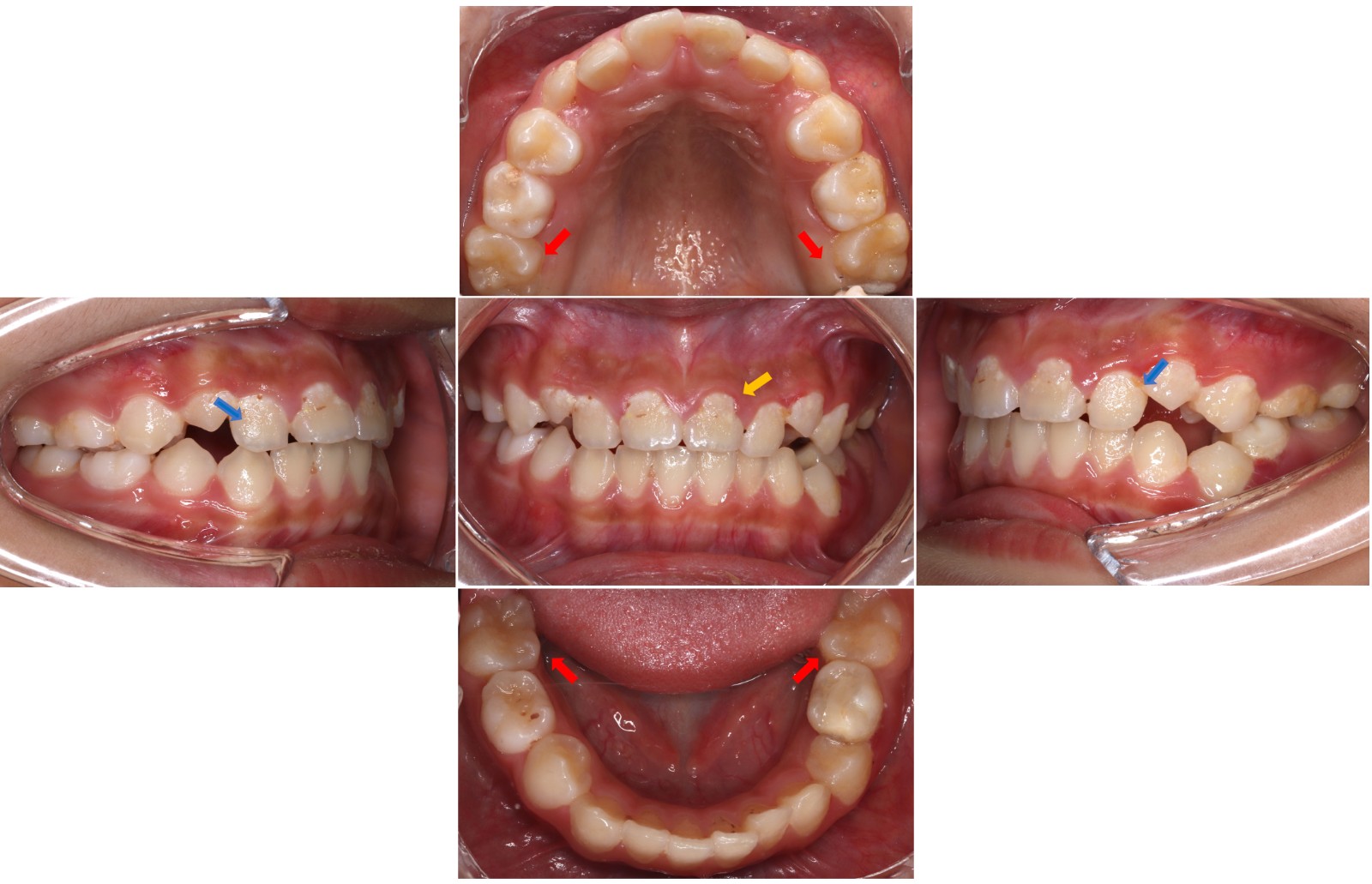 Intraoral photographs at the 10-week follow-up. The yellow arrow showing the intact restoration of 21, the red arrows showing the normal crowns of the first permanent molars, and the blue arrows showing plaque and debris accumulation.
