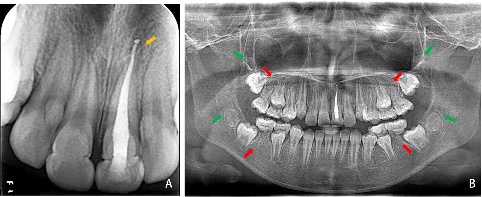 Radiographic findings at the 10-week follow-up. (A) Periapical radiograph. The yellow arrow showing no periapical radiolucency. (B) Panoramic radiograph. The red arrows showing no radiographic signs of periapical pathology with teeth 16, 26, 36, and 46, and the green arrows showing the third-molar tooth germs.