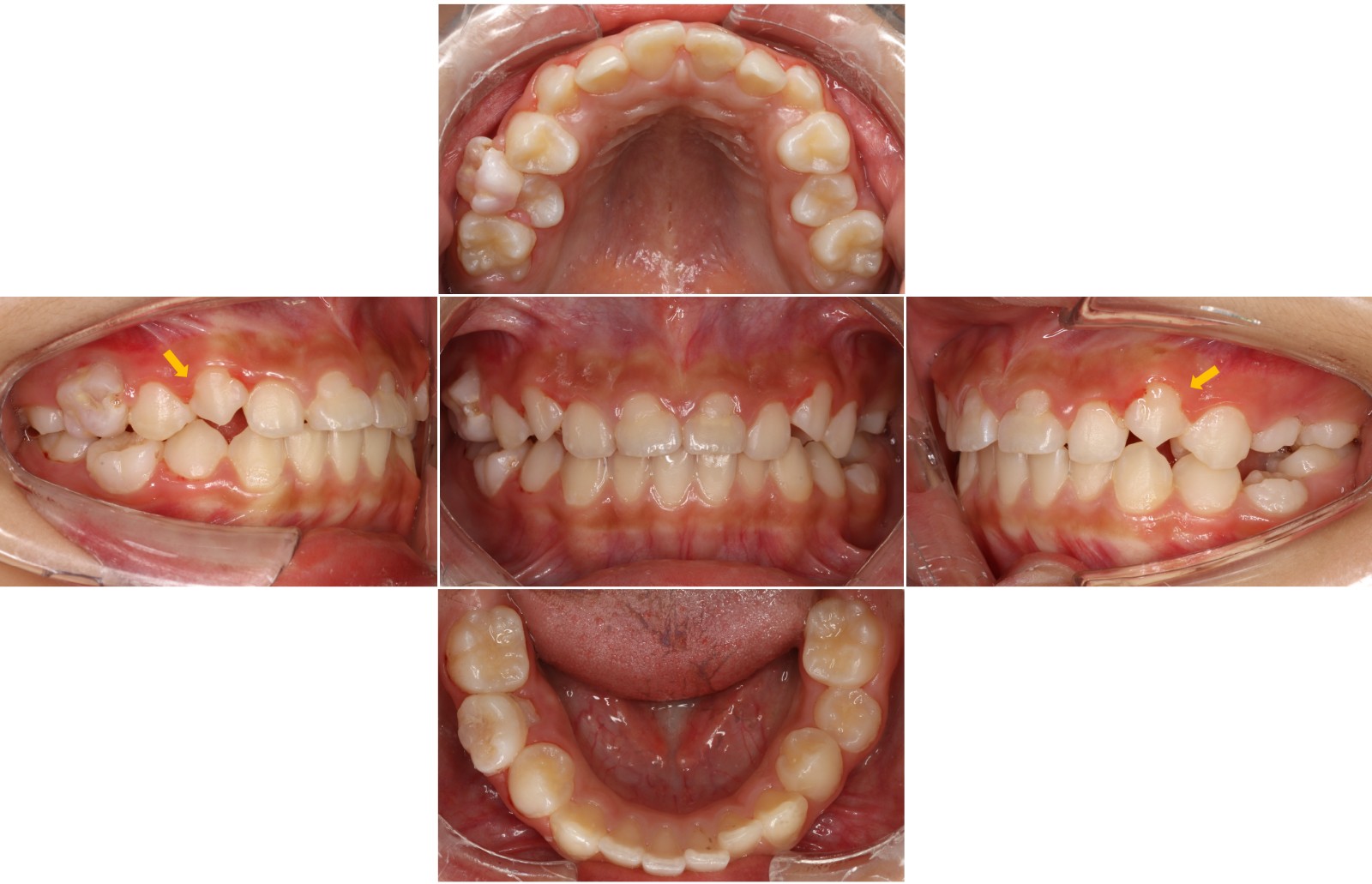 Intraoral photographs at the 9-month follow-up. The yellow arrows showing the cervical narrowing of teeth 13 and 23.