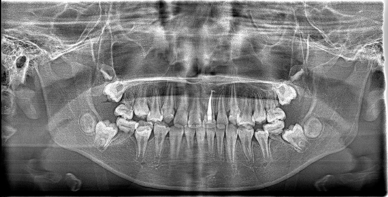 Panaramic radiograph at the 9-month follow-up.