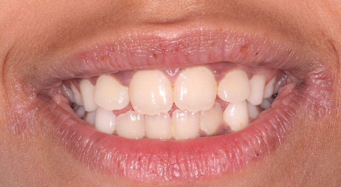 Extraoral findings. Clinical examination showing pale dry skin 
and dry lips with fissured and crusted commissures consistent with angular 
cheilitis. Multiple brown macules can also be observed on the upper lip.