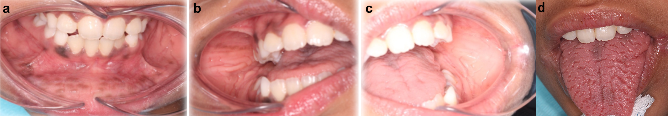Intraoral findings. (a) Intraoral examination showing 
multiple dark brown, flat discolorations involving the labial mucosa, gingiva, 
and tongue. (b,c) The buccal mucosa with multiple bilateral mucosal folds, 
creating a cobblestone-like appearance. (d) The dorsal surface of the tongue 
appeared fissured.